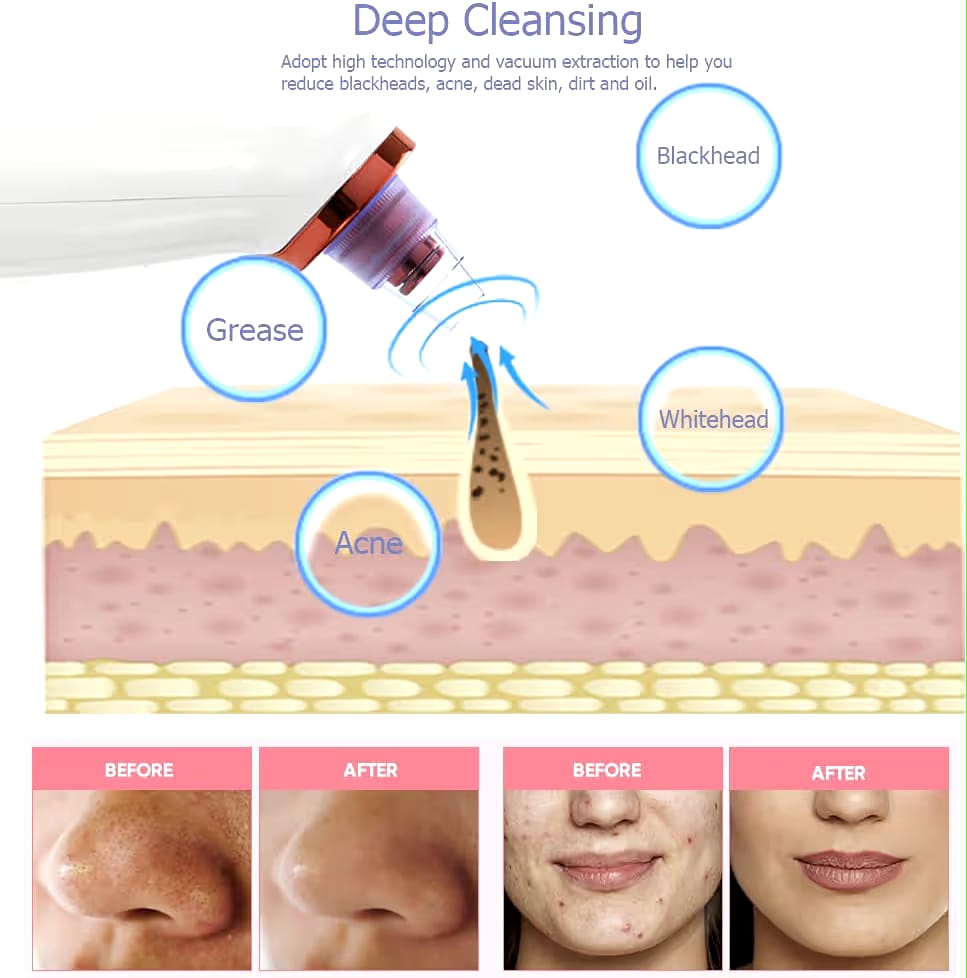 BLACKHEAD REMOVER PORE VACUUM CLEANER