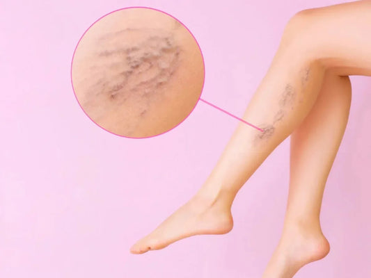 ROYAL PRESTIGE VARICOSE VEINS PATCH