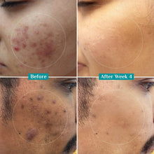 Pilgrim 10% Niacinamide Face Serum with 1% Zinc PCA