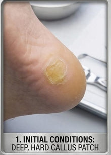 Foot Care Pedicure Callus Shaver Hard Skin Remover Foot Razor